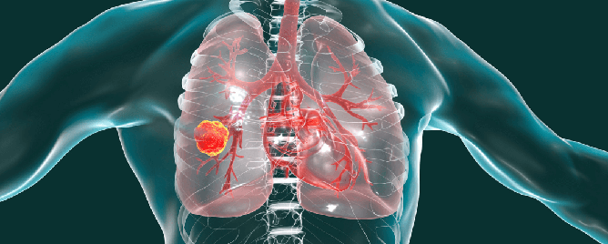 <br>Identified a gene that drives development of the second most common type of lung carcinoma, offering greater insight into how the disease might someday be treated.....<a href='https://nyulangone.org/news/key-genetic-code-change-drives-common-lung-cancer-type' target='_blank'>More</a>