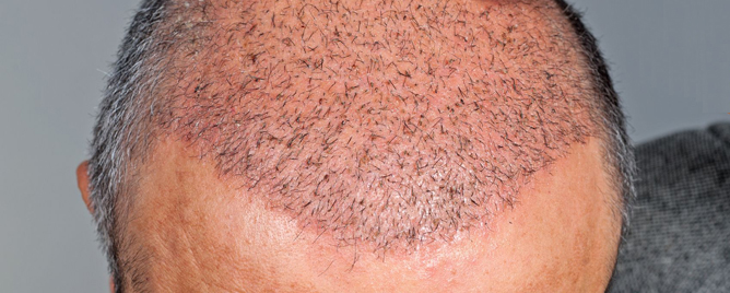 <br>Researchers have found that hair follicle transplants can promote scar rejuvenation by altering their architecture and genetic makeup.....<a href='https://www.imperial.ac.uk/news/242531/scars-mended-using-transplanted-hair-follicles/' target='_blank'>More</a>