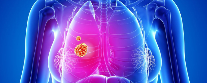 <br>Some lung cancer cells retain a “memory” of the healthy cell where they came from — one that might be exploited to make an emerging type of lung cancer treatment.....<a href='https://www.mskcc.org/news/lung-cancer-cells-memories-suggest-new-strategy-for-improving-treatment' target='_blank'>More</a>