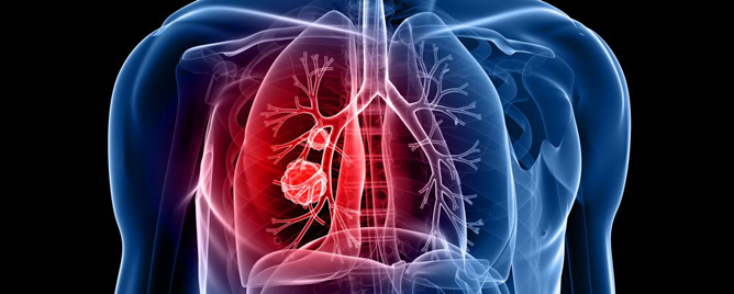 <br>Two therapeutic drugs benefit mice with LKB1-mutated, non-small cell lung cancer, potentially paving the way for clinical trials in humans.....<a href='https://www.salk.edu/news-release/new-combination-of-drugs-works-together-to-reduce-lung-tumors-in-mice/' target='_blank'>More</a>